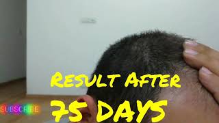 Result After 75 days of Hair Transplant  Hair Transplant 2018 [upl. by Lenuahs605]