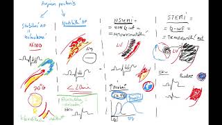 Akutní koronární sy 3 Infarkt myokardu by Coiled CZECH NSTEMI STEMI Q ST elevation ACS EKG [upl. by Haleemaj739]