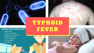 Typhoid Fever Symptoms – Causes Symptoms and Pictures of Enteric fever in Men women [upl. by Sholom]