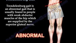 Trendelenburg Gait  Everything You Need To Know  Dr Nabil Ebraheim [upl. by Godspeed985]