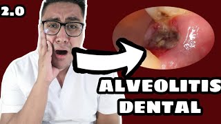 ALVEOLITIS DENTAL2 QUE HACER EN EL 2020 ¿INFECCIÓN DESPUÉS DE UNA EXTRACCIÓN [upl. by Aramoiz214]