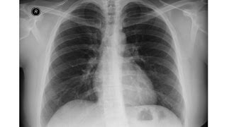 Chest xray Right lower lobe collapse [upl. by Viv]