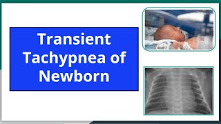 Transient tachypnea of newborn mbbs newbornneonatology neetpg pediatrics nursing ttn [upl. by Aldos141]