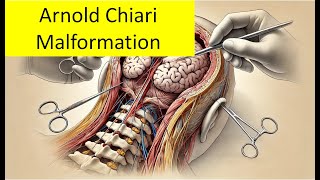 Arnold Chiari Malformation [upl. by Ehrlich]