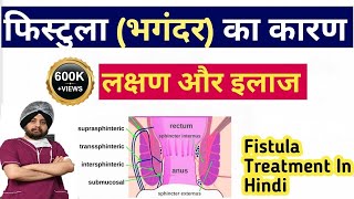 Fistula in Hindi Definition Symptoms Treatment Surgery How Fistula Cure Without Surgery [upl. by Onateag]