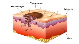 What Is Melanoma  Skin Cancer [upl. by Moazami]