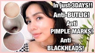 ANTIBUTLIG  ANTIPIMPLE MARKS  ANTIBLACKHEADS ON NOSE  CLEARED SKIN IN JUST 3 DAYS  Kim Tadeo [upl. by Phio]