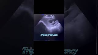 Triplet pregnancy on Ultrasound [upl. by Ettennor]