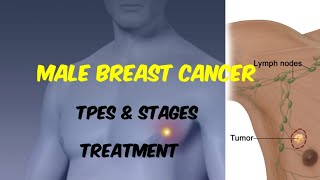 Male Breast Cancer  Types  Stages  Sign amp Symptoms  Investigations  Treatment [upl. by Ennaitsirhc]