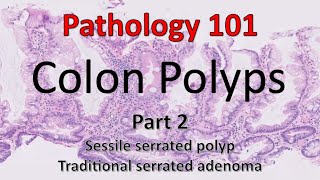 Colon Polyps  Part 2  Pathology 101 [upl. by Nahta]