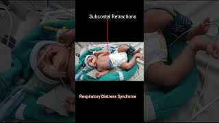 Respiratory Distress Syndrome [upl. by Emanuele]