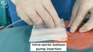 IABP  INTRA AORTIC BALLOON PUMP [upl. by Terhune]