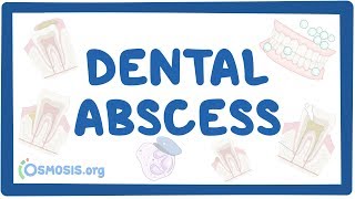 Dental abscess  causes symptoms diagnosis treatment pathology [upl. by Rivy]