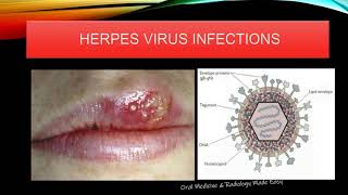 ORAL HERPES VIRUS INFECTION PART1 [upl. by Eelyk406]