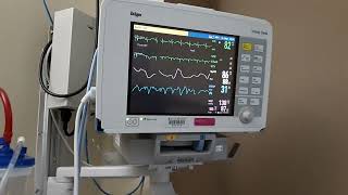 How Read PATIENT MONITOR in Hospital Resp SpO2 Pls HR Arr NBP Alarm Meaning Use Monitoring System [upl. by Burta]