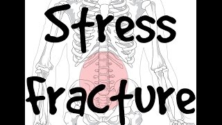 Physical Therapy Update 1 Stress Fracture amp Exertional Compartment Syndrome [upl. by Osbert]