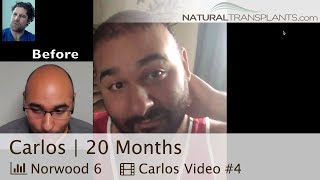 Hair Transplantation amp Hair Restoration Results 20 Months Carlos [upl. by Anirrak648]