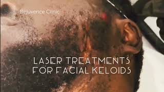 Laser Treatment for Keloids on the Face [upl. by Littman]