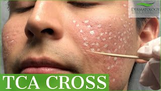 Acne Scar Removal with TCA Cross 80  Los Angeles  Dr Ben Behnam [upl. by Dirgis591]