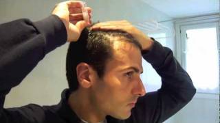 Tratamiento laser capilar domiciliario  Hair loss laser treatment home use [upl. by Noraa]