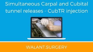 Cubital Tunnel release using Walant [upl. by Qahsi]