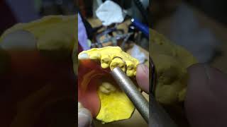 Pustiso na may Kawit Acrylic Denture [upl. by Gnagflow594]