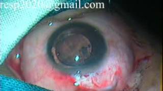 Capsular Tension Ring Insertion CTR in Subluxated Cataract By Dr Sudhir Singh [upl. by Tarsuss]