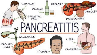 Understanding Pancreatitis [upl. by Libbna]