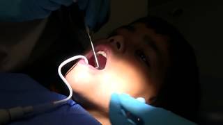 Tooth filling in school dental clinic Part 8 Tooth filling [upl. by Brigid864]