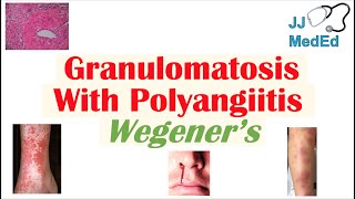 Granulomatosis with Polyangiitis Wegener’s granulomatosis  Symptoms Diagnosis Treatment [upl. by Annahc]