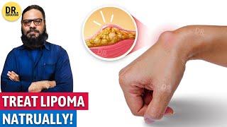 Lipoma Ka Qudrati Ilaj  Natural Remedies for Lipoma  UrduHindi  Dr Ibrahim [upl. by Eirased]