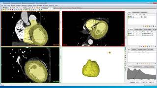 How to Include the Myocardium in Heart Models  Mimics Innovation Suite  Materialise Medical [upl. by Lach]