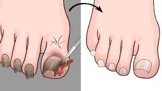 ASMR Ingrown Toenail Removal Treatment Animation  ENJO Relaxing [upl. by Zola731]