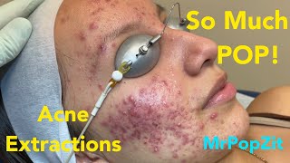 So much pop Acne extractions on severe inflammatory acne Multiple blackheads and whiteheads [upl. by Reema]