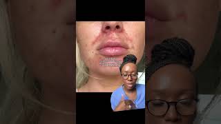 This is NOT AcnePerioral dermatitis explained [upl. by Ldnek]