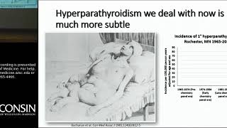 9718 Hyperparathyroidism Beyond Stones and Bones [upl. by Assilym]