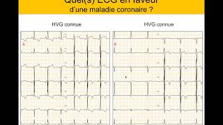 Infarctus ou et HVG  Quiz Dr Taboulet [upl. by Sutit531]