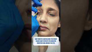 Xanthelasma Treatment  Skin Clinic  Kolkata  Skin Treatment  youtubereels youtubeshorts [upl. by Sybilla]