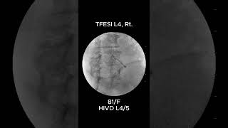 How to Accurately Perform L4 Transforaminal Epidural Steroid Injection TFESI 2 [upl. by Oirogerg]