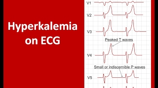 Hyperkalemia Effect on Heart  Raised Potassium  Hyperkalemia ECG [upl. by Josefa370]