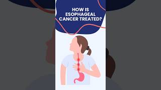 Esophagus cancer treatment in Delhi Noida DrAshishSachan [upl. by Hogg]