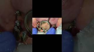 Proper Alveoloplasty  No gum shrinkage even after 2 years  Mandible full implants [upl. by Adnovaj]