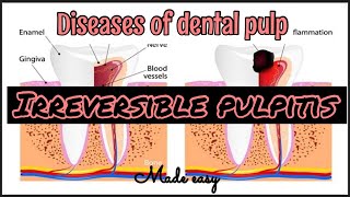 IRREVERSIBLE PULPITIS II INFLAMMATION OF PULP II DISEAES OF PULP II SERIES PART 3 [upl. by Macleod186]