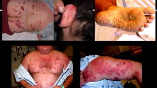 Stelara Side Effects  Stelara causes drug induced psoriasis  Biologic problems [upl. by Other28]