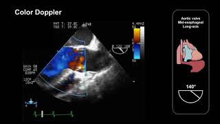 Assessing the aortic valve using TEE midesophageal longaxis view [upl. by Deacon]