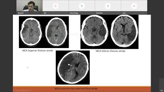 Stroke Clinical Approach amp Localization [upl. by Burgwell]