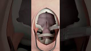 Craniectomy surgery educationalvideo [upl. by Mildrid]