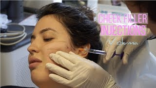 Voluma Cheek Fillers Before amp After Vlog  Solange Nicole [upl. by Rogers]