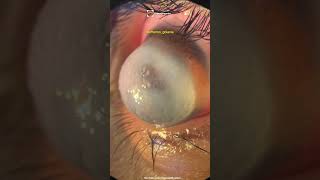 The Beautiful Cases Keratoconus Keratoglobus Corneal Hydrops [upl. by Ihc]