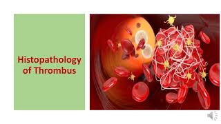 THROMBOSIS TYPES  HISTOPATHOLOGY CONSEQUENCES DIAGNOSIS AND PREVENTION [upl. by Mitinger]